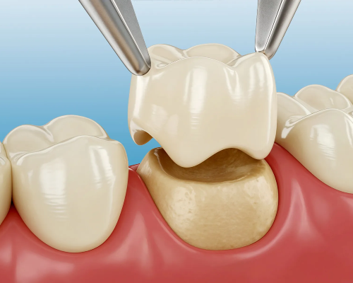 Zirconia Crowns